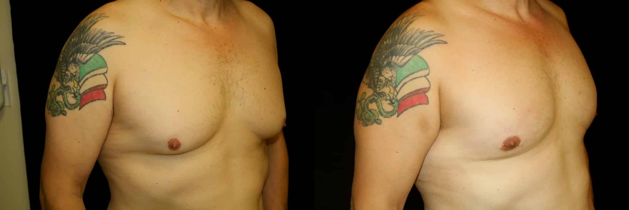 Gynecomastia Patient 12 Before & After Details