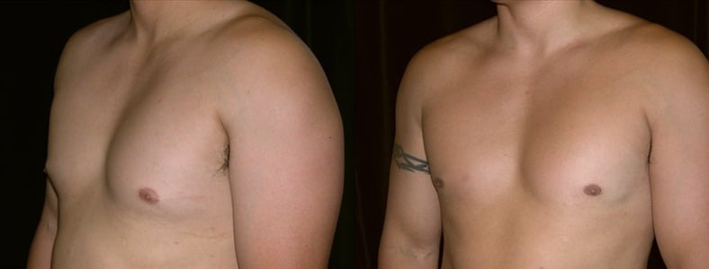 Gynecomastia Patient 13 Before & After Details