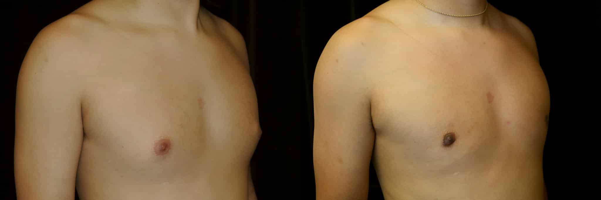 Gynecomastia Patient 7 Before & After Details