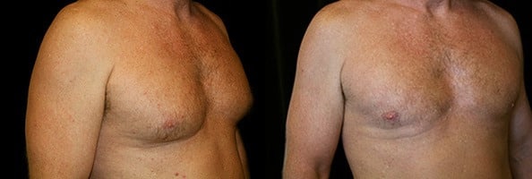 Gynecomastia Patient 7 Before & After Details