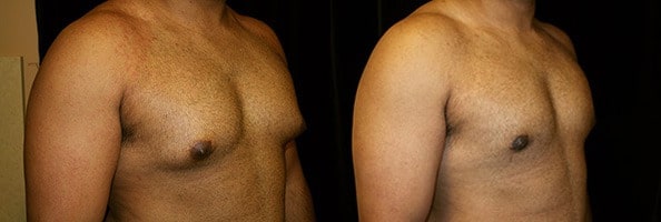 Gynecomastia Patient 18 Before & After Details