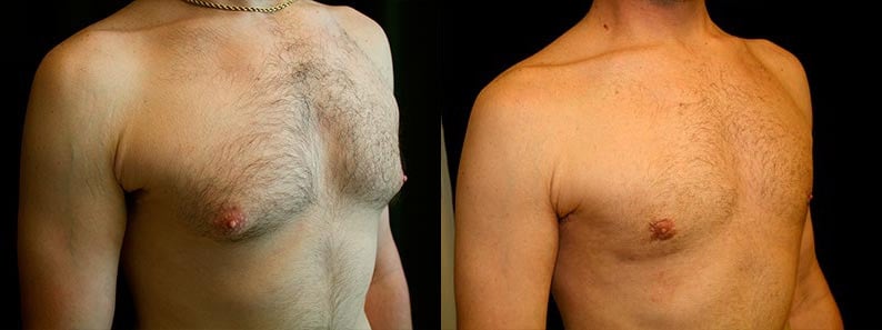 Gynecomastia Patient 14 Before & After Details