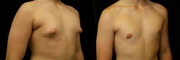 Gynecomastia Patient 13 Before & After Details