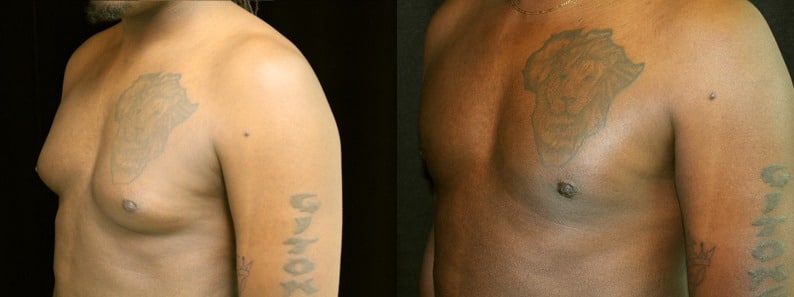 Gynecomastia Patient 14 Before & After Details