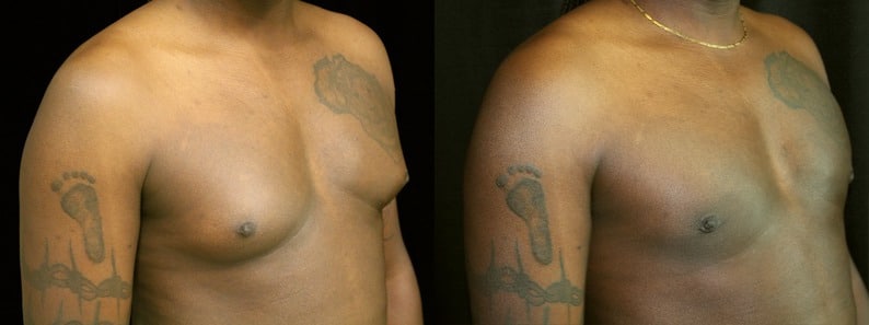 Gynecomastia Patient 14 Before & After Details