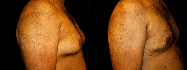 Gynecomastia Patient 20 Before & After Details