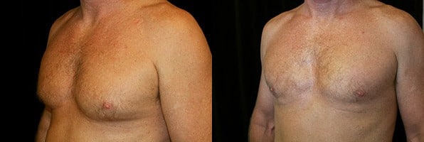 Gynecomastia Patient 7 Before & After Details