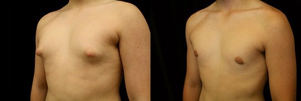 Gynecomastia Patient 13 Before & After Details