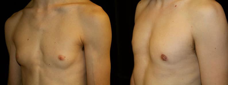 Gynecomastia Patient 2 Before & After Details