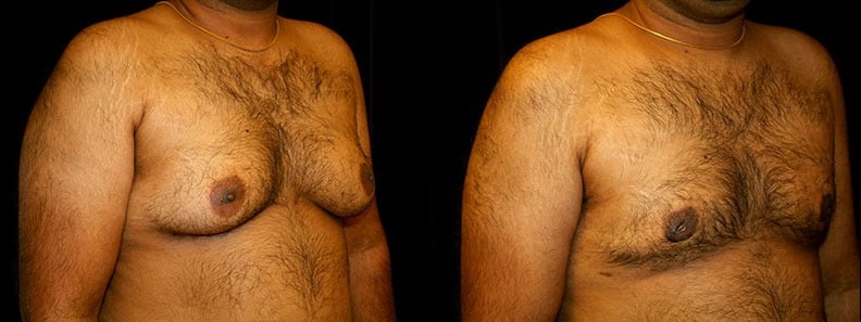 Gynecomastia Patient 20 Before & After Details