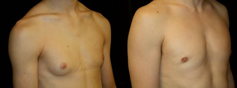 Gynecomastia Patient 2 Before & After Details