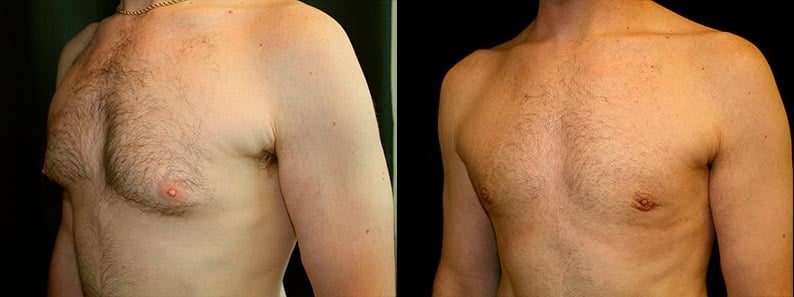 Gynecomastia Patient 14 Before & After Details