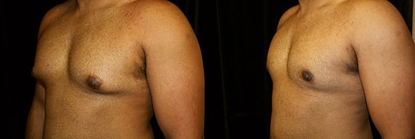 Gynecomastia Patient 18 Before & After Details