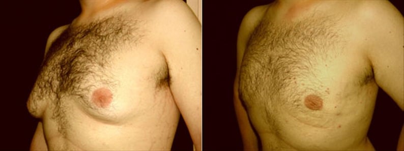 Gynecomastia Patient 4 Before & After Details