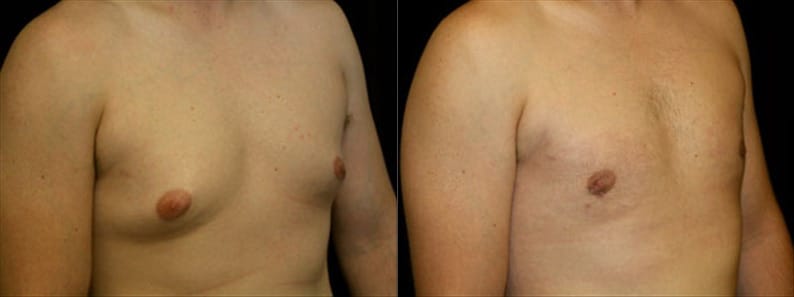 Gynecomastia Patient 9 Before & After Details