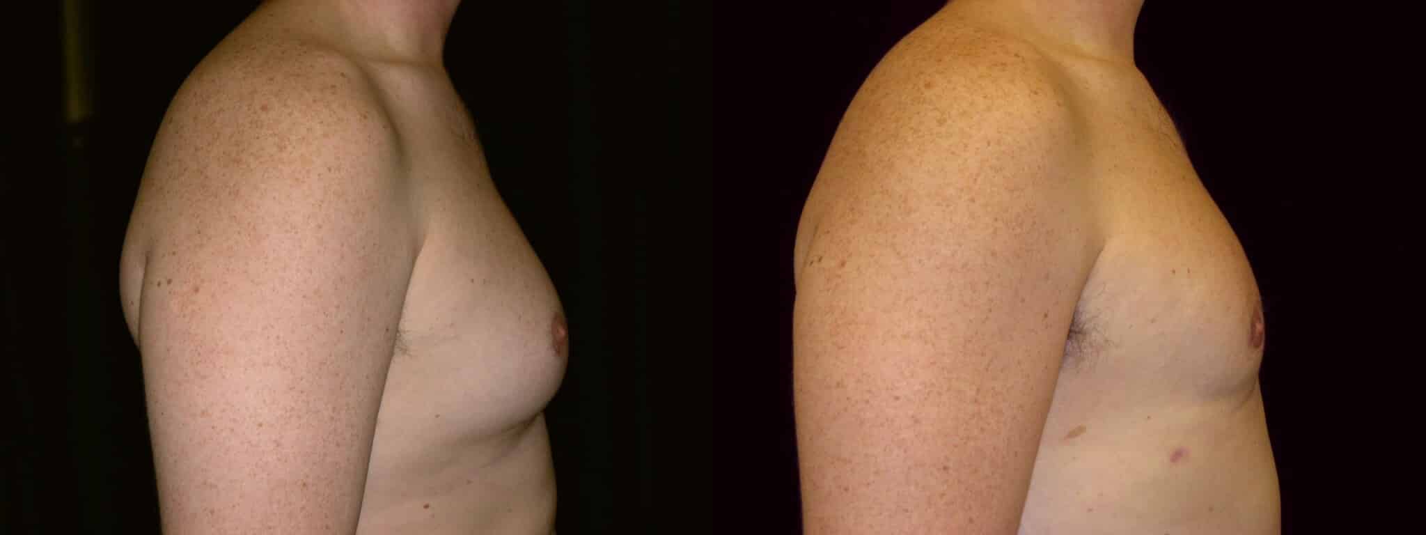 Gynecomastia Patient 17 Before & After Details