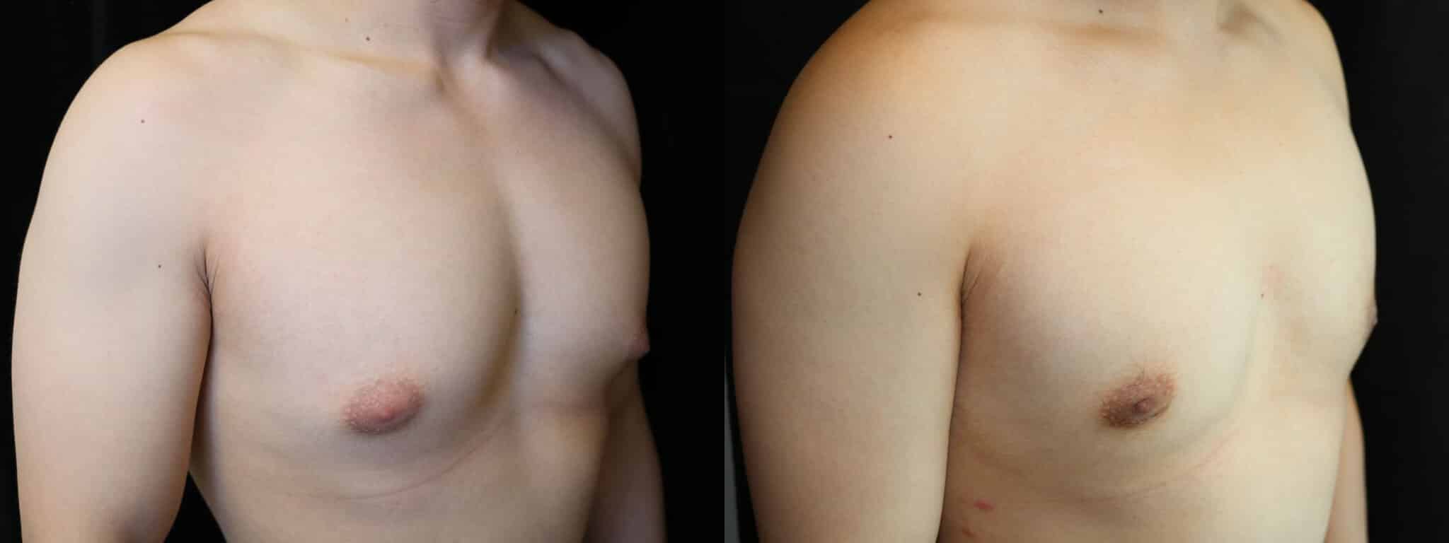 Gynecomastia Patient 1 Before & After Details