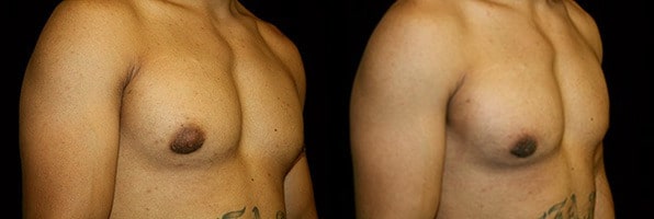 Gynecomastia Patient 17 Before & After Details