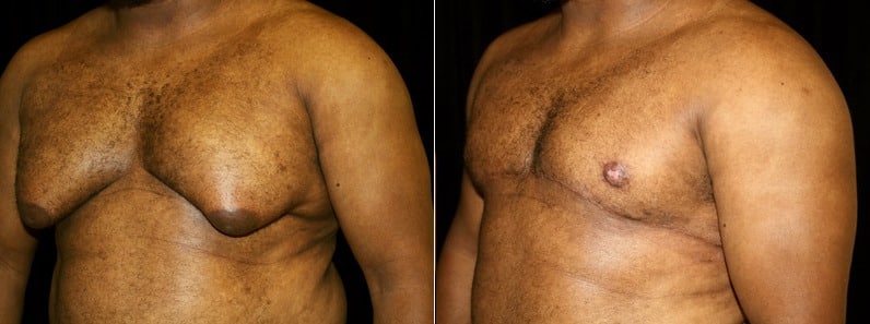 Gynecomastia Patient 15 Before & After Details