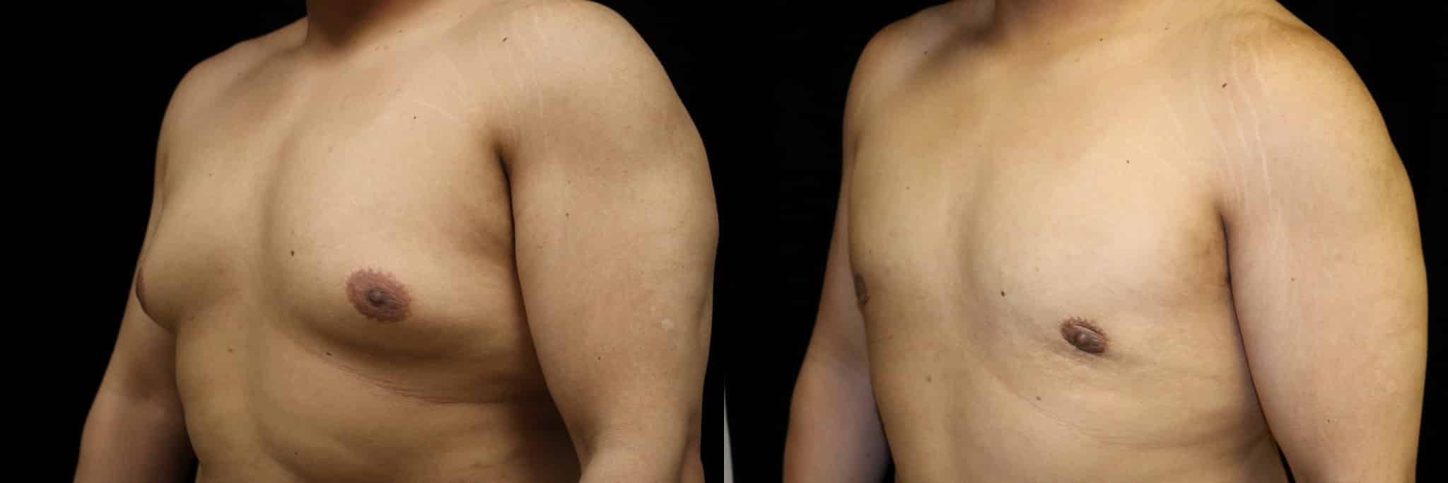 Gynecomastia Patient 7 Before & After Details