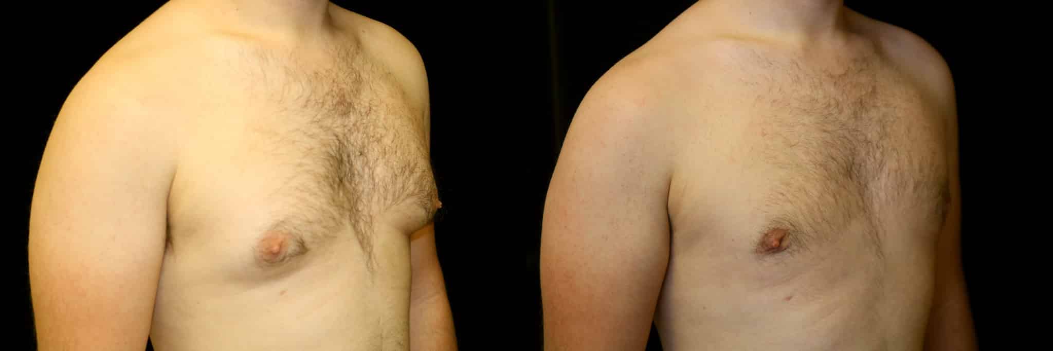 Gynecomastia Patient 16 Before & After Details