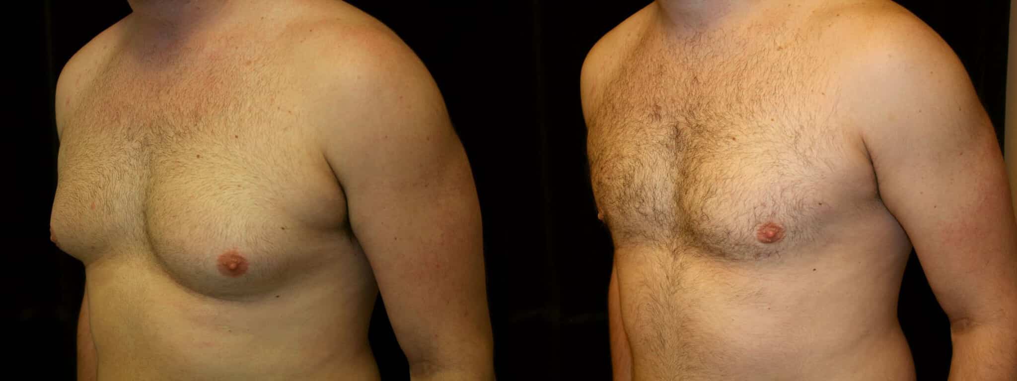 Gynecomastia Patient 14 Before & After Details