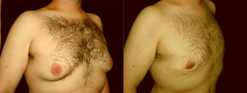 Gynecomastia Patient 4 Before & After Details