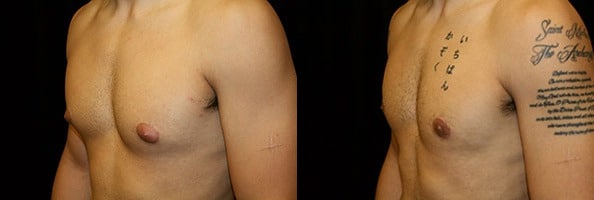 Gynecomastia Patient 11 Before & After Details