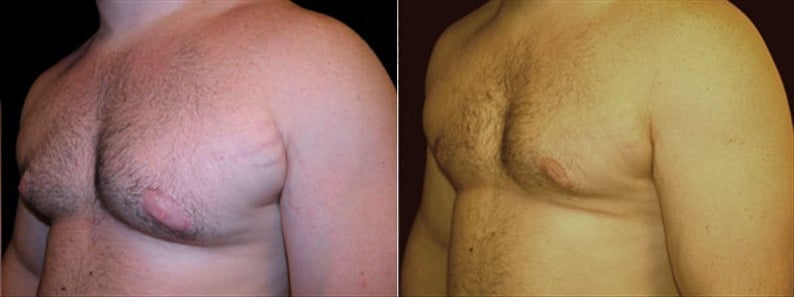 Gynecomastia Patient 8 Before & After Details