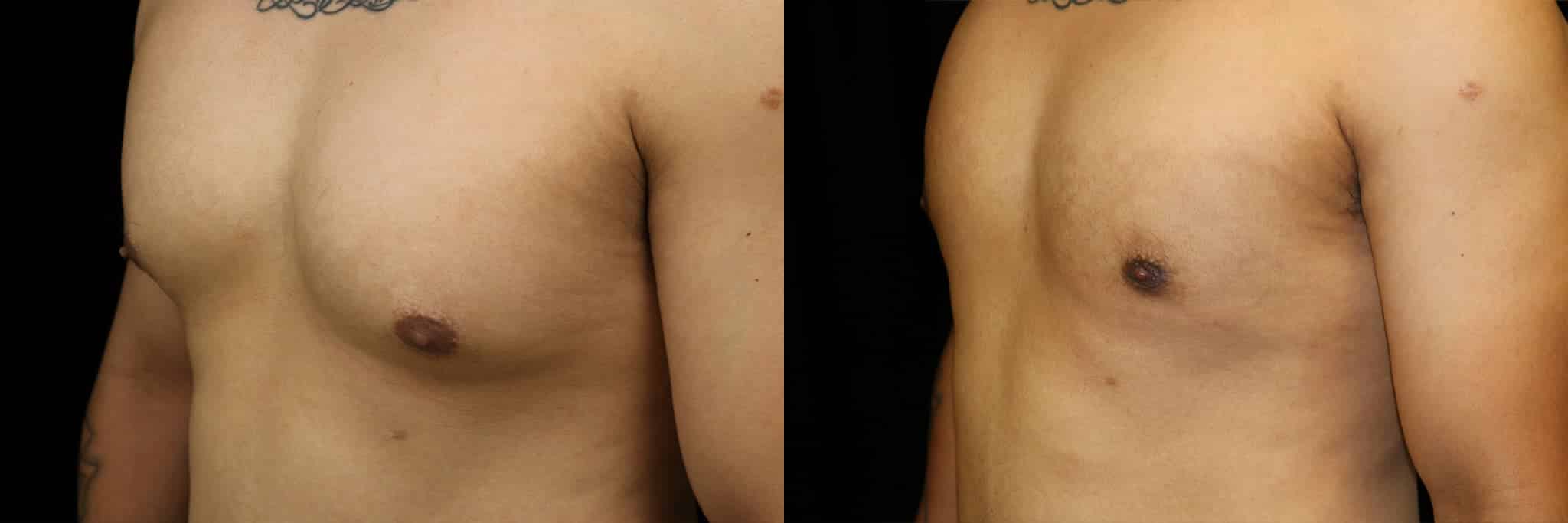 Gynecomastia Patient 12 Before & After Details