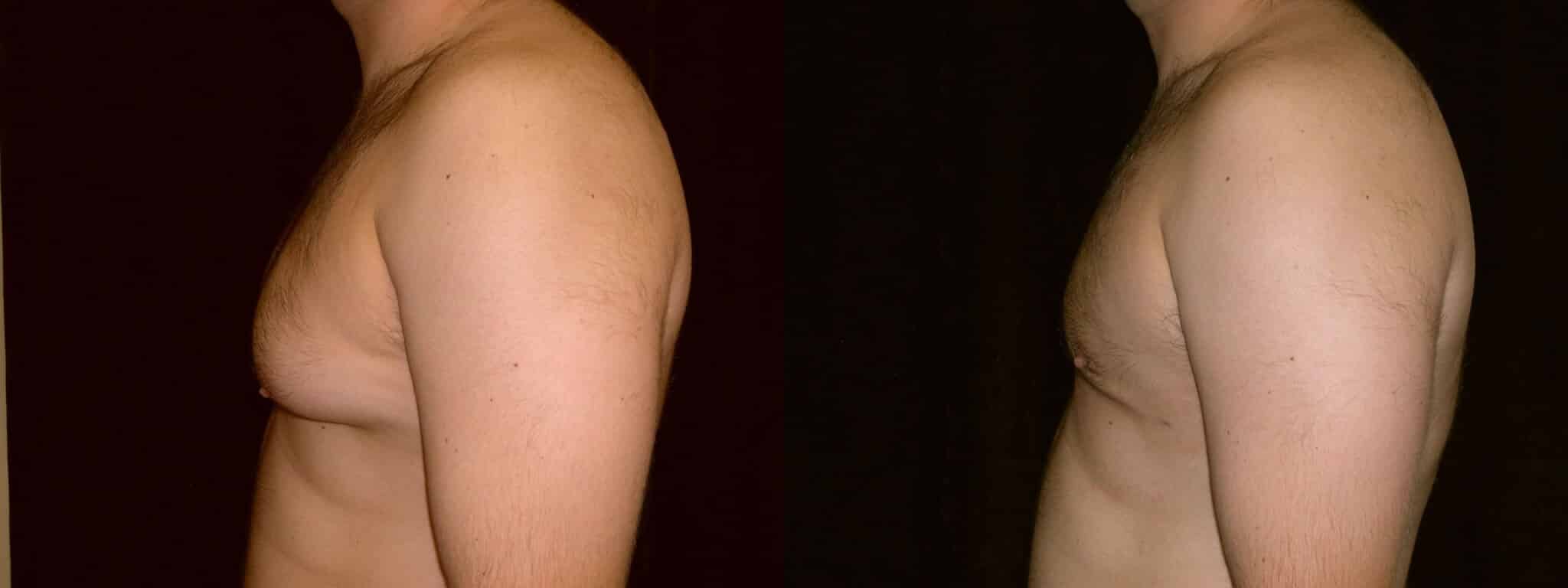 Gynecomastia Patient 8 Before & After Details