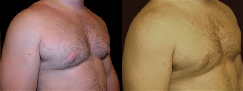 Gynecomastia Patient 8 Before & After Details