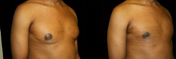 Gynecomastia Patient 10 Before & After Details