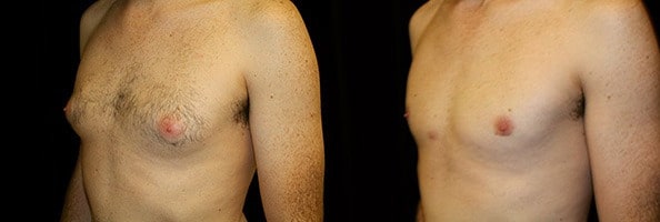 Gynecomastia Patient 12 Before & After Details