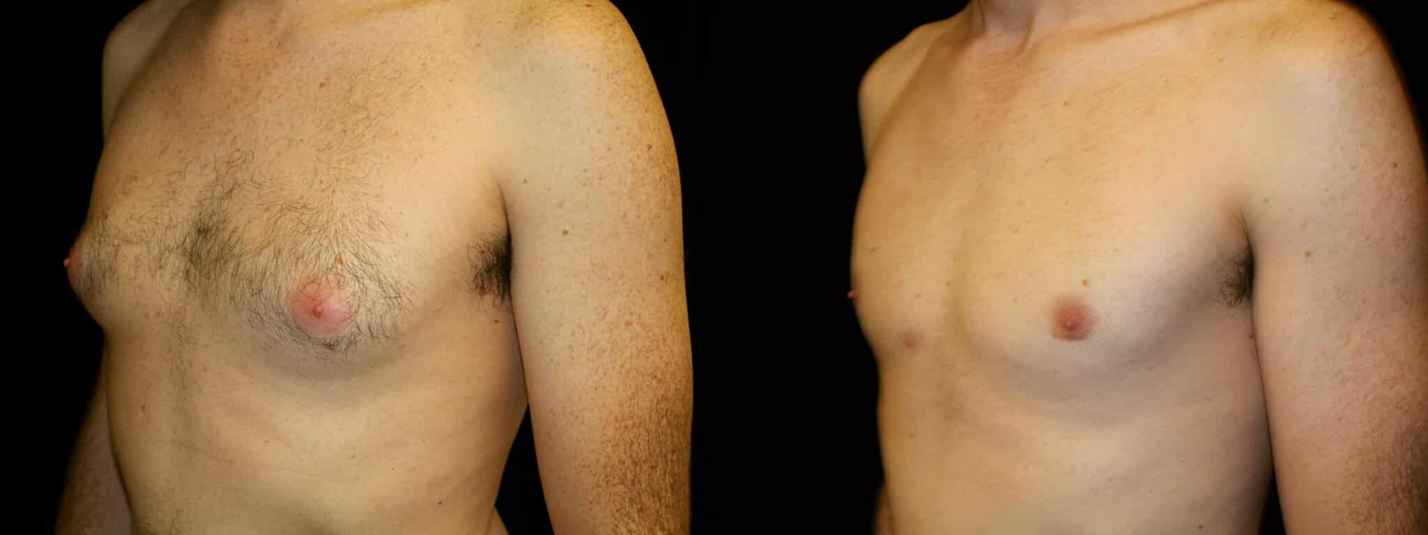 Gynecomastia Patient 19 Before & After Details