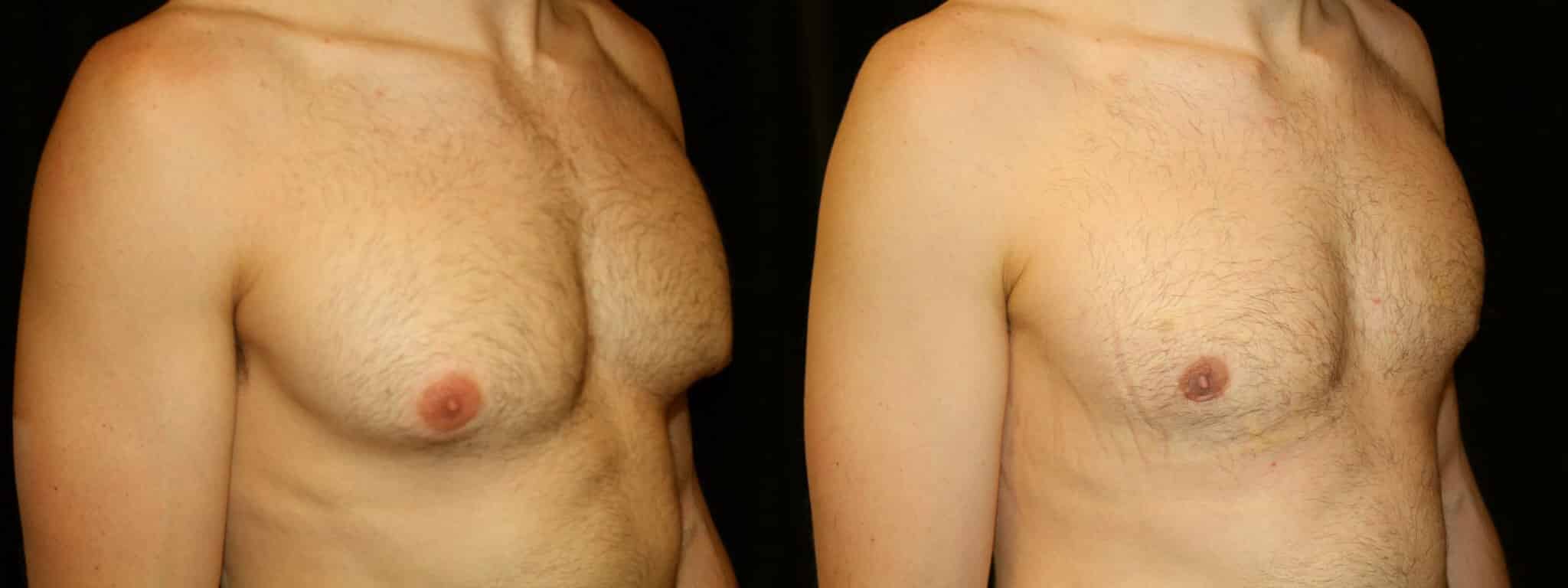 Gynecomastia Patient 19 Before & After Details