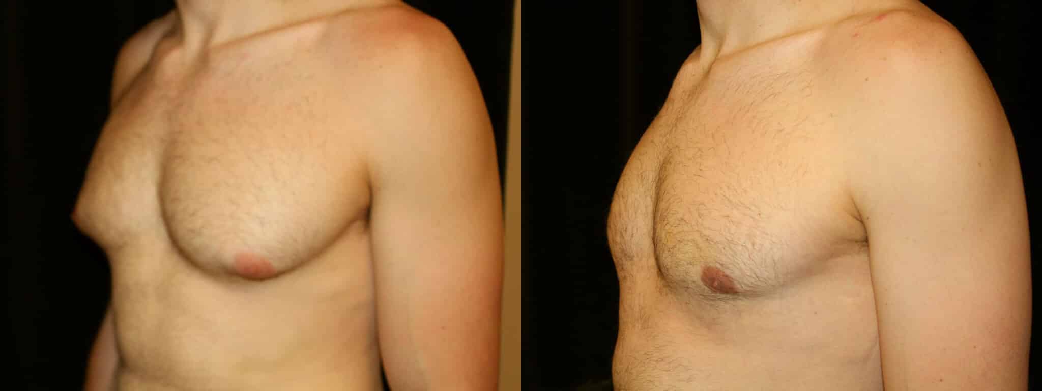 Gynecomastia Patient 19 Before & After Details