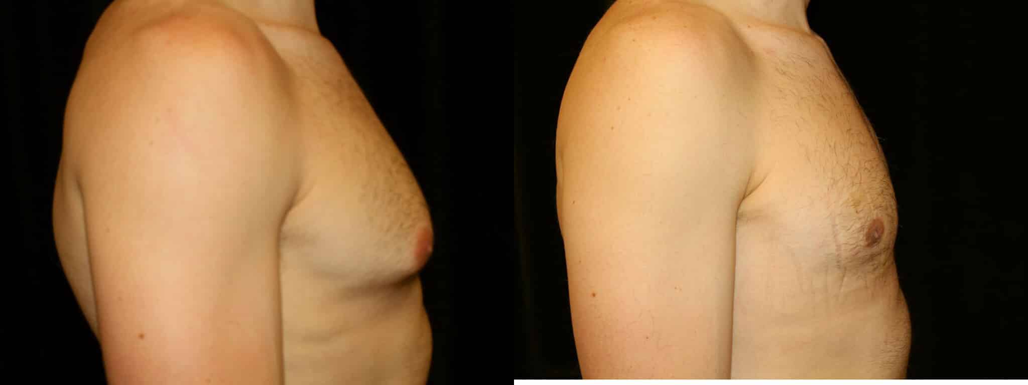 Gynecomastia Patient 19 Before & After Details