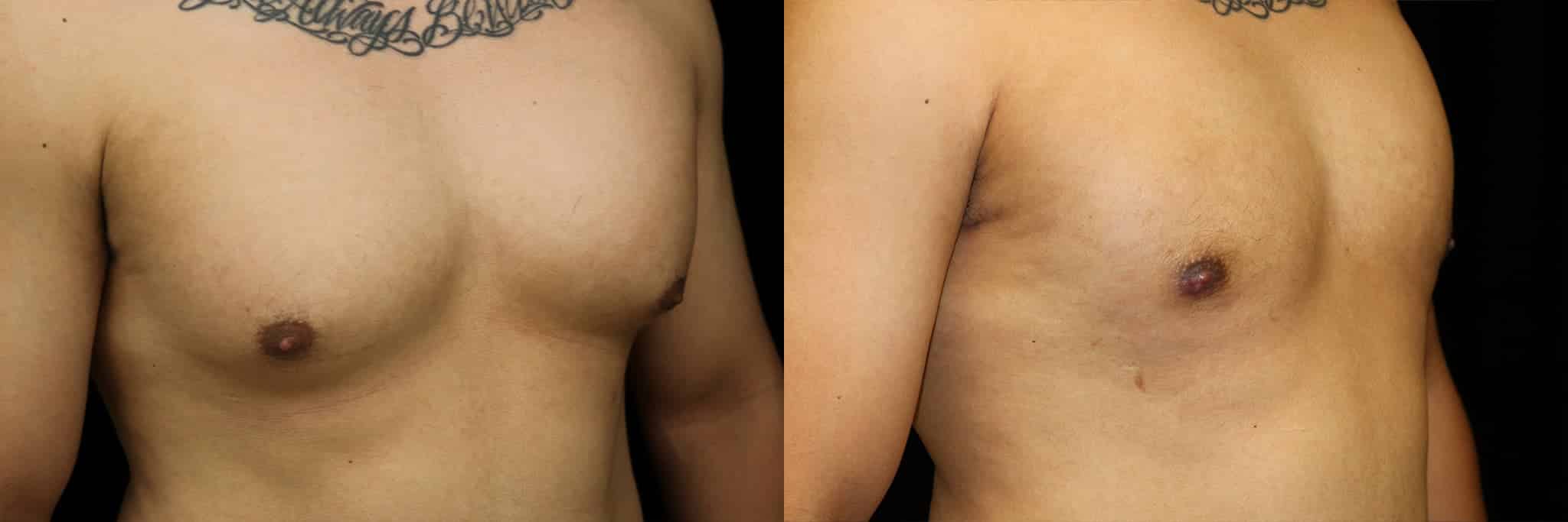 Gynecomastia Patient 12 Before & After Details