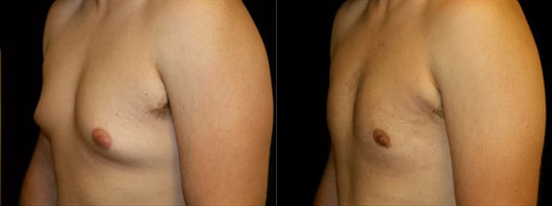 Gynecomastia Patient 9 Before & After Details