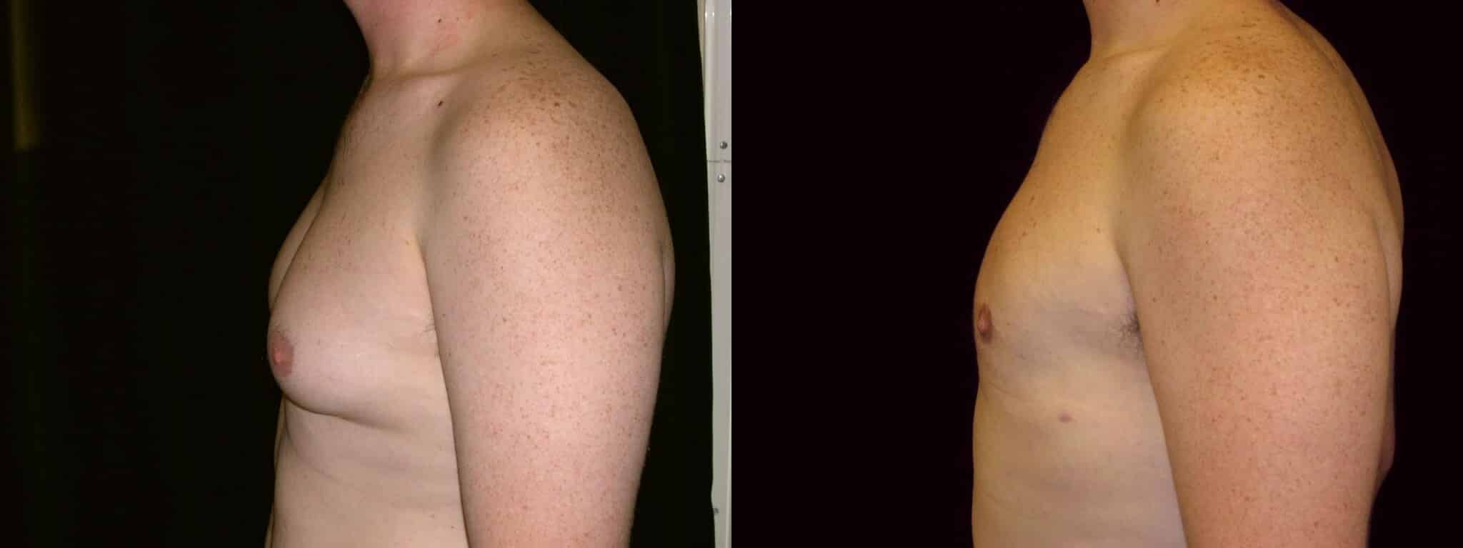 Gynecomastia Patient 17 Before & After Details