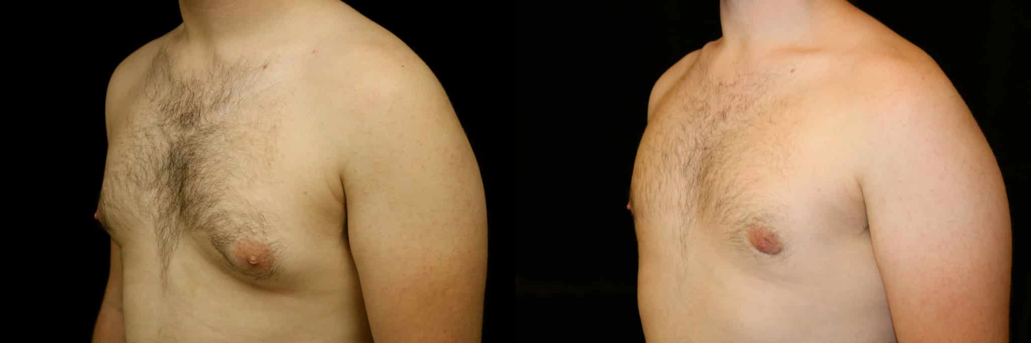 Gynecomastia Patient 16 Before & After Details