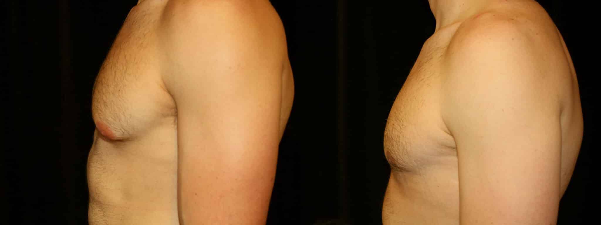 Gynecomastia Patient 19 Before & After Details