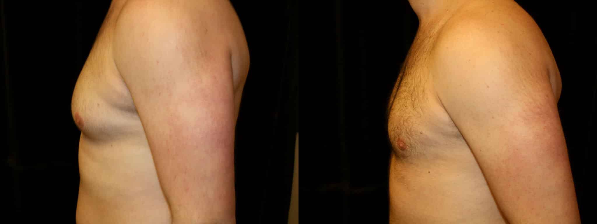 Gynecomastia Patient 14 Before & After Details