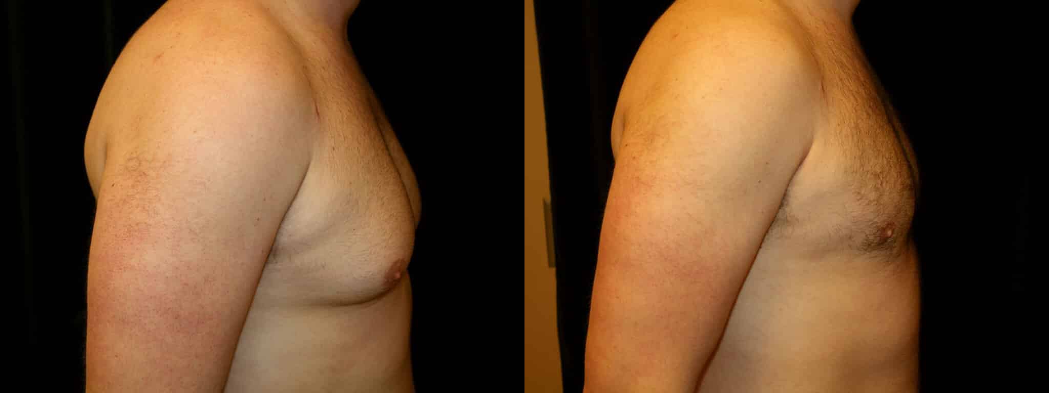 Gynecomastia Patient 14 Before & After Details