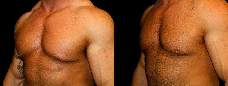 Gynecomastia Patient 18 Before & After Details