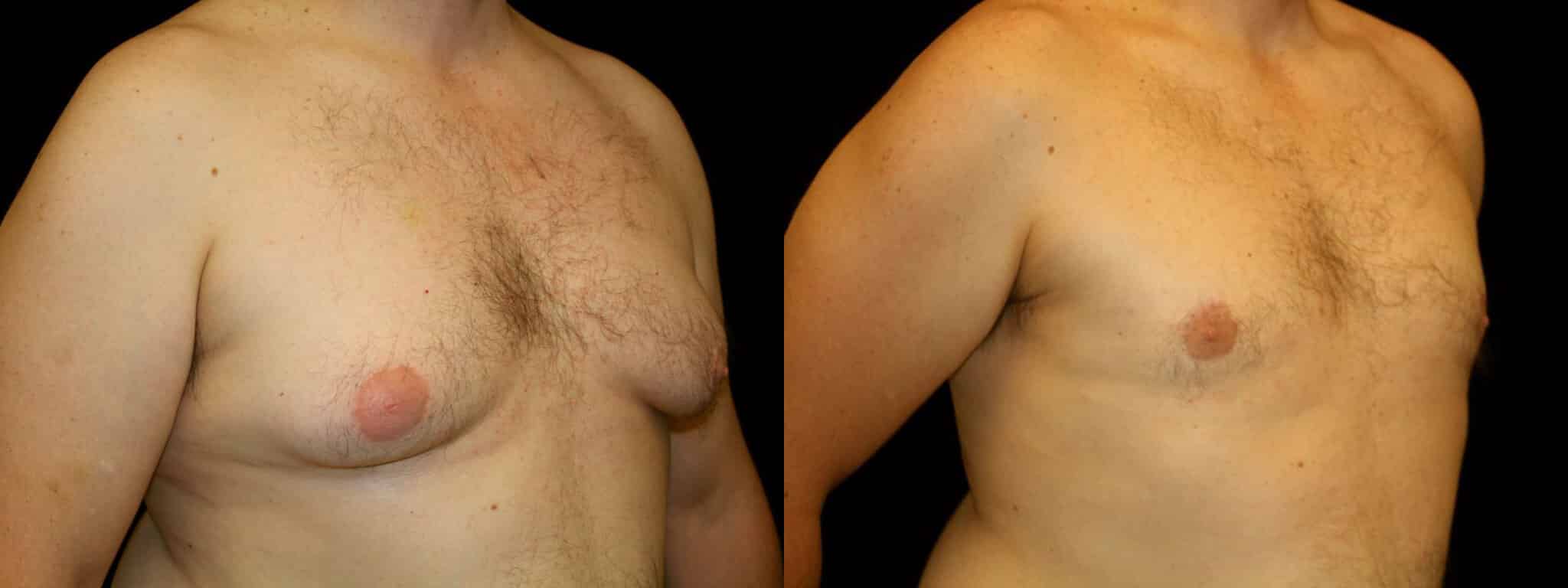 Gynecomastia Patient 11 Before & After Details