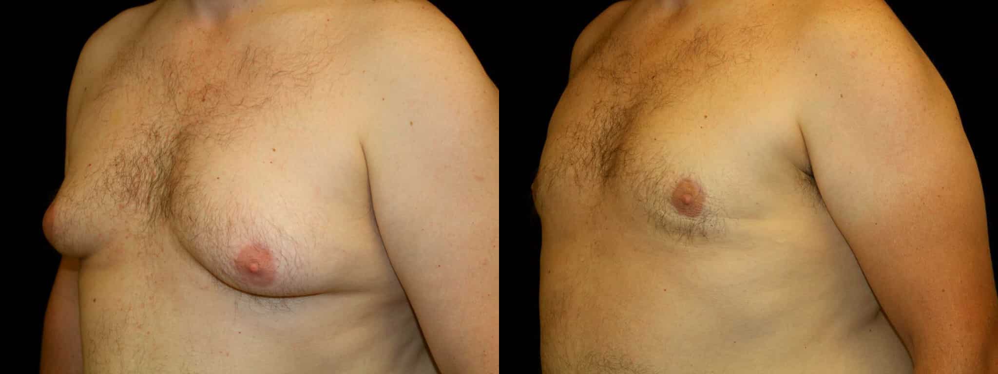 Gynecomastia Patient 11 Before & After Details