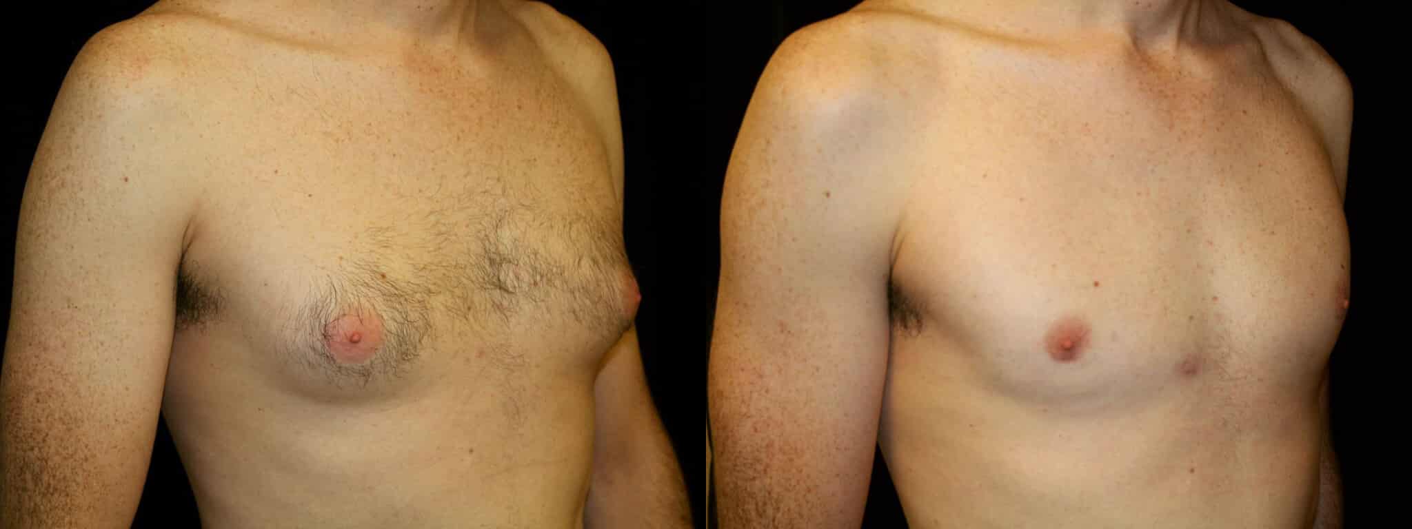 Gynecomastia Patient 19 Before & After Details