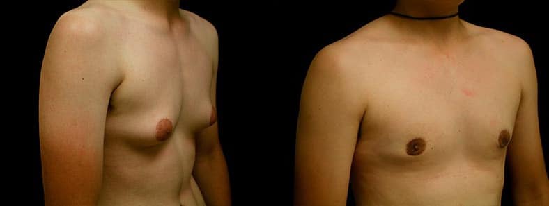 Gynecomastia Patient 2 Before & After Details